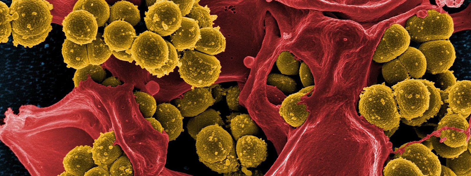 Close up of cancer cells in human body